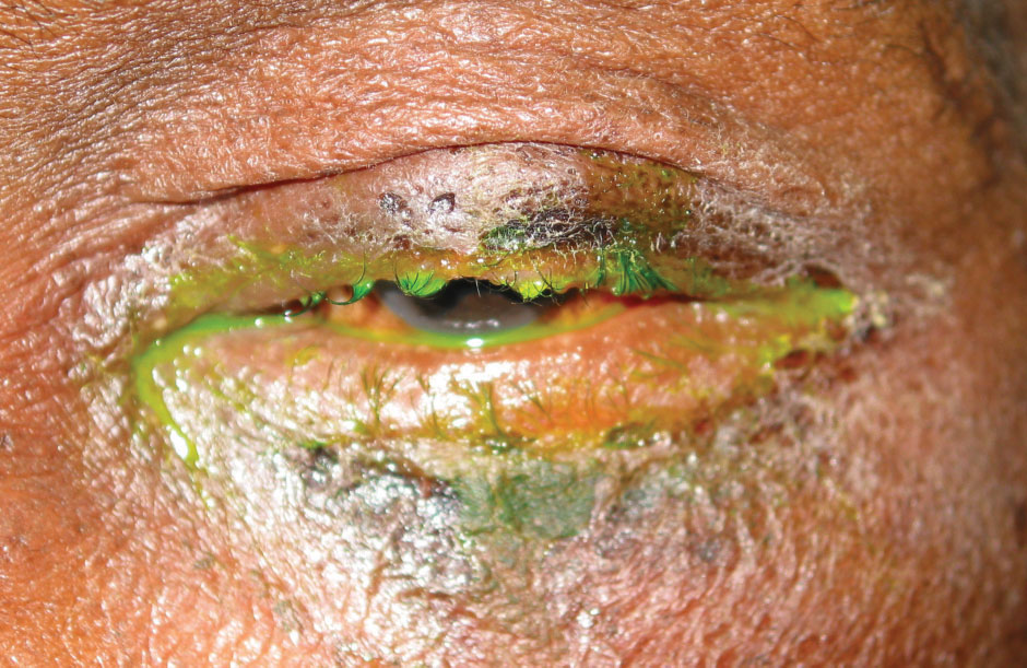 There was substantial variability in the pathogens causing acute infectious conjunctivitis in this study, with purulent discharge a common sign. This suggests that further diagnostic workup may be necessary to inform antibiotic stewardship.