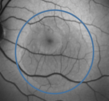 Outcome analysis revealed that history of steroid use was associated with a decreased need for CSCR treatment and better final visual acuity; eyes with lower baseline best-corrected visual acuity were associated with increased need for treatment and worse final visual acuity.