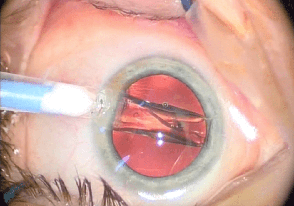 Reducing a cataract patient’s post-op treatment regimen to one eye drop (an NSAID, in this case) by injecting the other two medications can ease the individual’s recovery and reduce the likelihood of compliance problems. This study found most outcomes as good or better than triple-drop therapy.