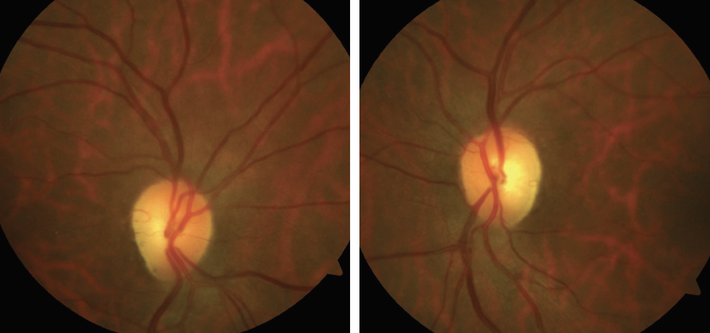 This study found that a large optic disc most commonly presented in patients with a vasospastic phenotype and in those from racial and ethnic minority backgrounds.