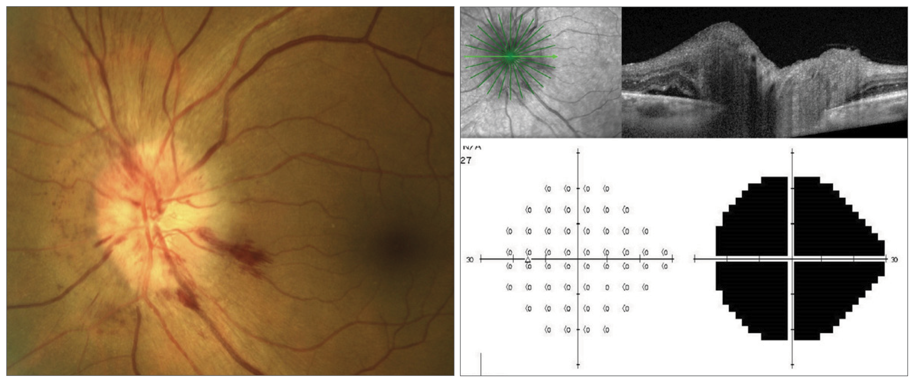 Patients with AAION generally present with poor VA, but in rare cases, they may present with normal VA, emphasizing the importance of giant cell arteritis workup in older adults with acute vision loss. 