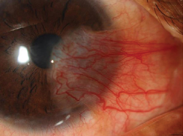 Patients treated for primary pterygium who received mitomycin C were less inclined to experience regrowth in this study.