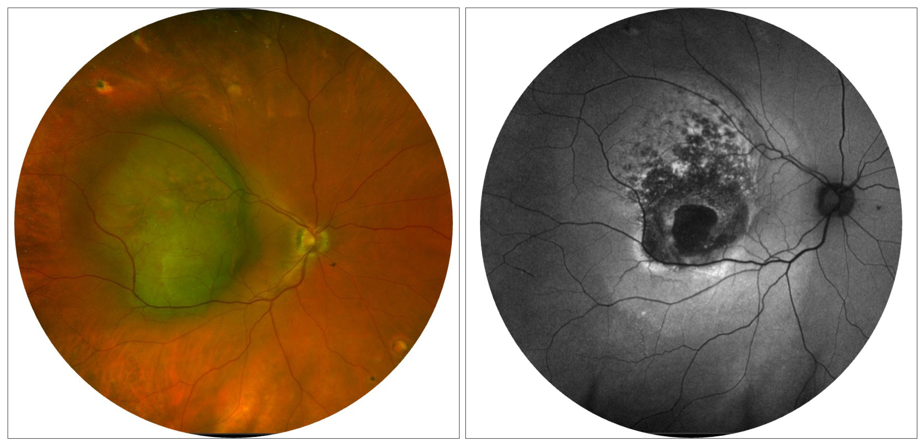 A recent study proposes that metastases of uveal melanoma could have spread from small tumors during the gap between diagnosis and treatment and remained dormant for a decade before manifesting clinically.