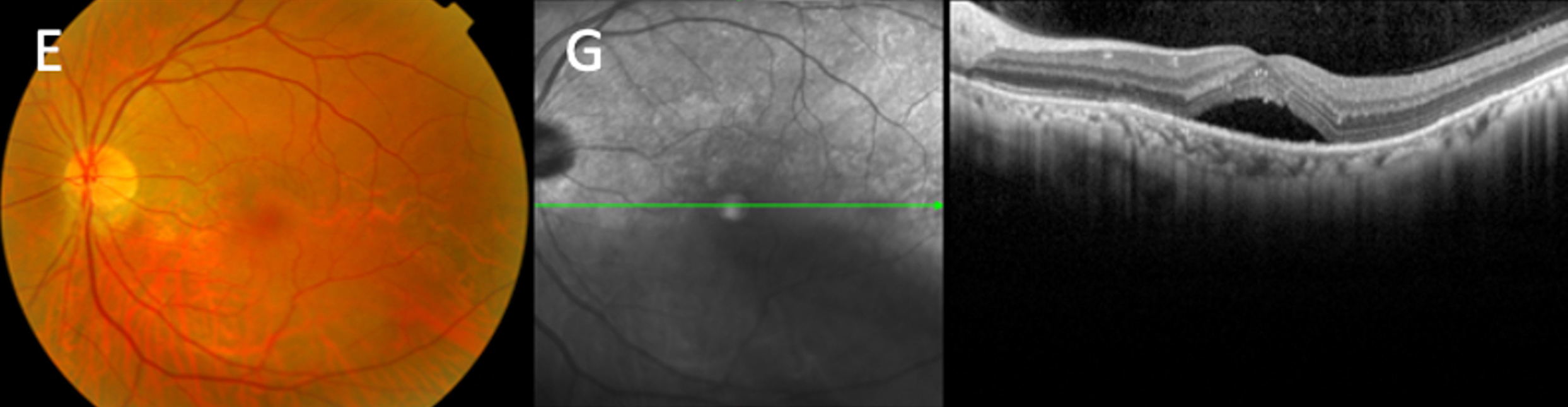 Treatment modalities in patients with staphyloma-induced serous maculopathy showed no significant change in BCVA vs. untreated eyes, suggesting a wait-and-see approach may be preferred. 