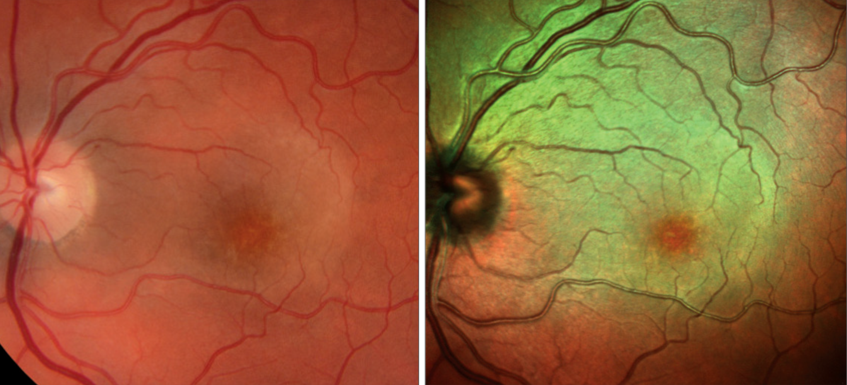 When presented with cases of intraocular inflammation, clinicians should have an elevated level of suspicion for syphilitic uveitis in patients meeting certain profile characteristics described here, as it is commonly missed on initial diagnosis. 