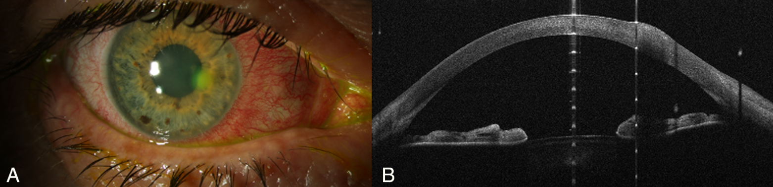 A patient with contact lens–associated Pseudomonas keratitis and symptom onset within the last 24 hours. (A) Slit-lamp photo revealing a paracentral corneal infiltrate and conjunctival hyperemia. (B) AS-OCT demonstrates an increase in corneal thickness (tissue gain) at the lesion area. 