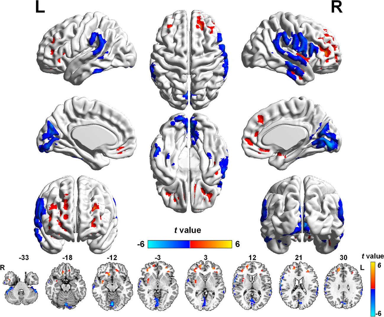 Glaucoma can cause psychological disturbances in patients, including depression and anxiety, even at early stages. These MRIs from the study show brain regions with altered blood flow values in POAG patients. Blue = decreased flow, red = increased flow). Certain regions are also responsible for mood regulation and cognitive ability.