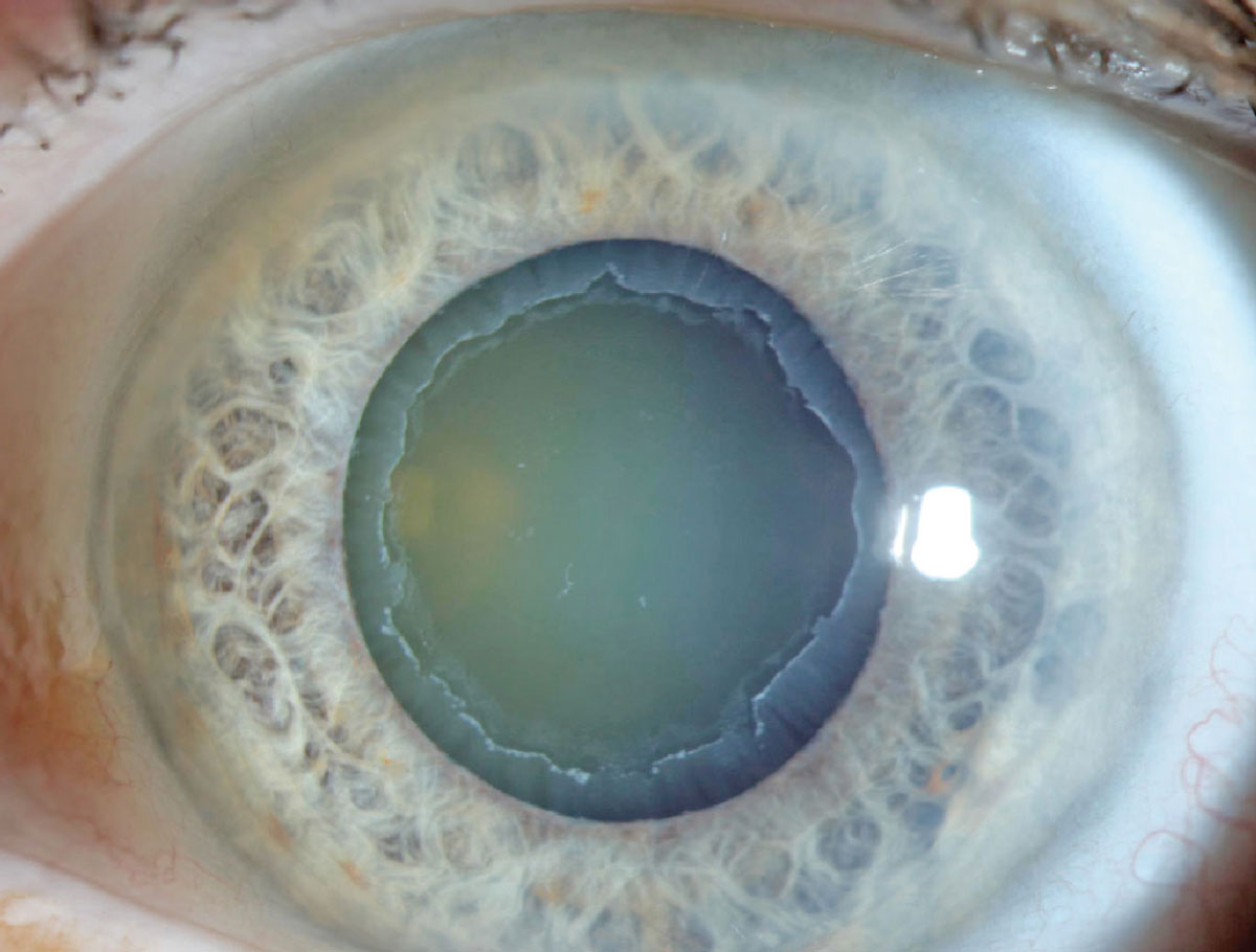PEX can cause notable effects to the cornea and iris.