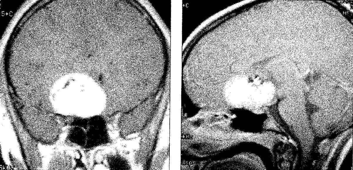 A coronal (left) and mid-sagittal (right) MRI. Several experts testified that a year earlier, the tumor would have been far smaller and treatable with gamma knife radiation.