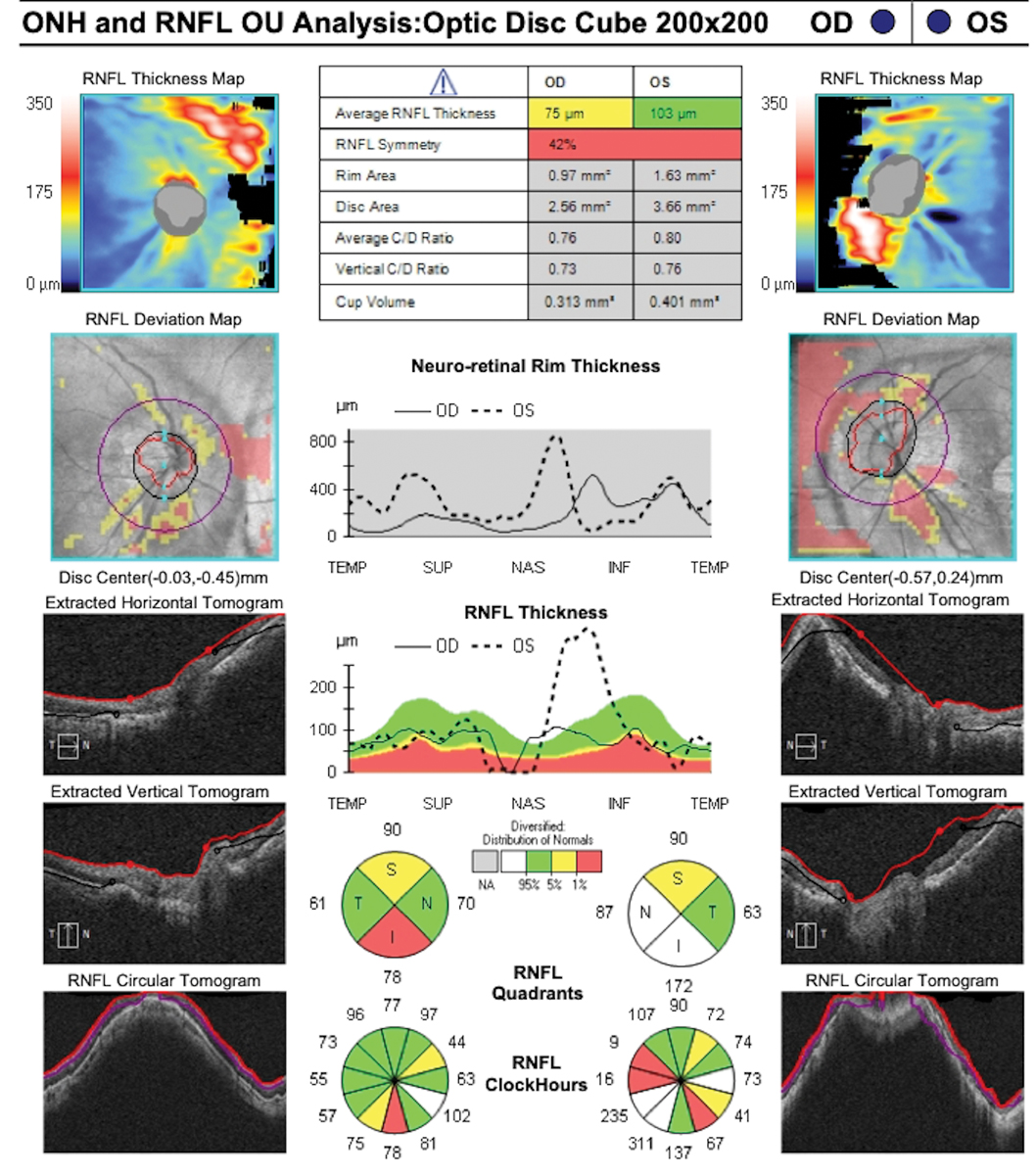Macular posterior staphyloma with severe choroidal thinning and RPE disruption on spectral domain OCT.