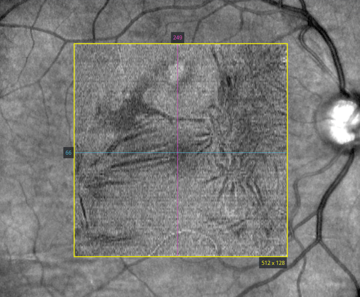 Epiretinal membrane following barrier laser photocoagulation of retinal break en face. 