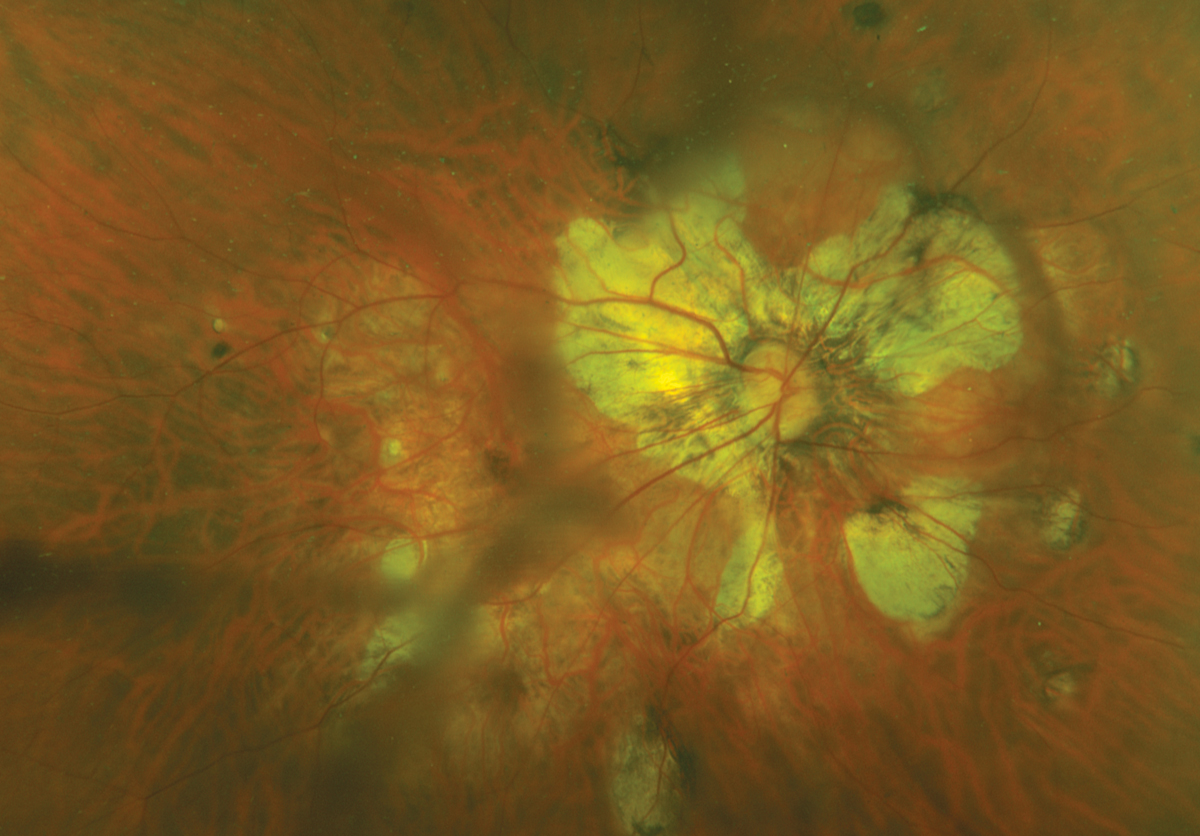 Patchy chorioretinal atrophy in a high myope with posterior staphyloma.