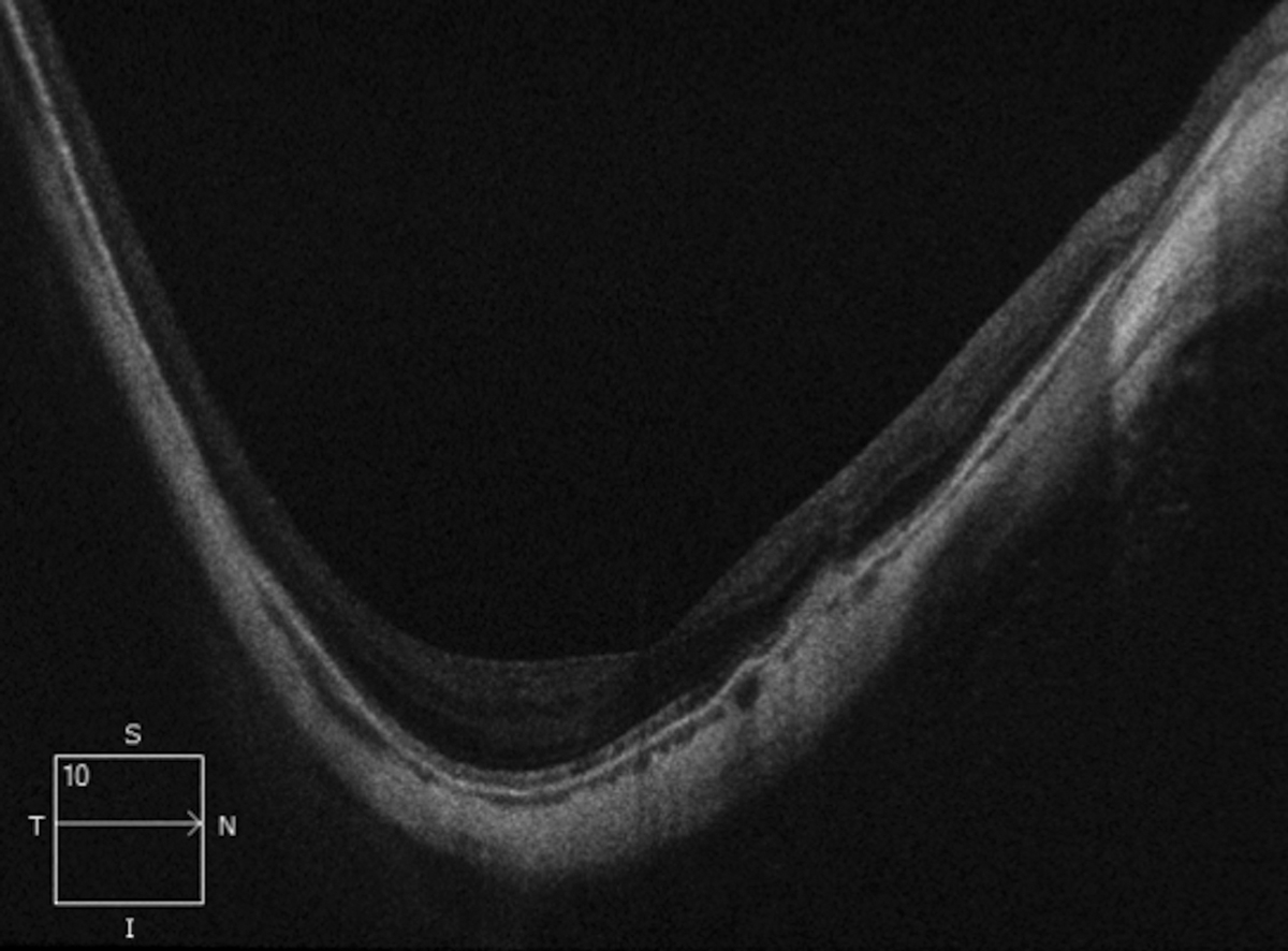 Segmentation error and imaging acquisition error due to parapapillary staphyloma.