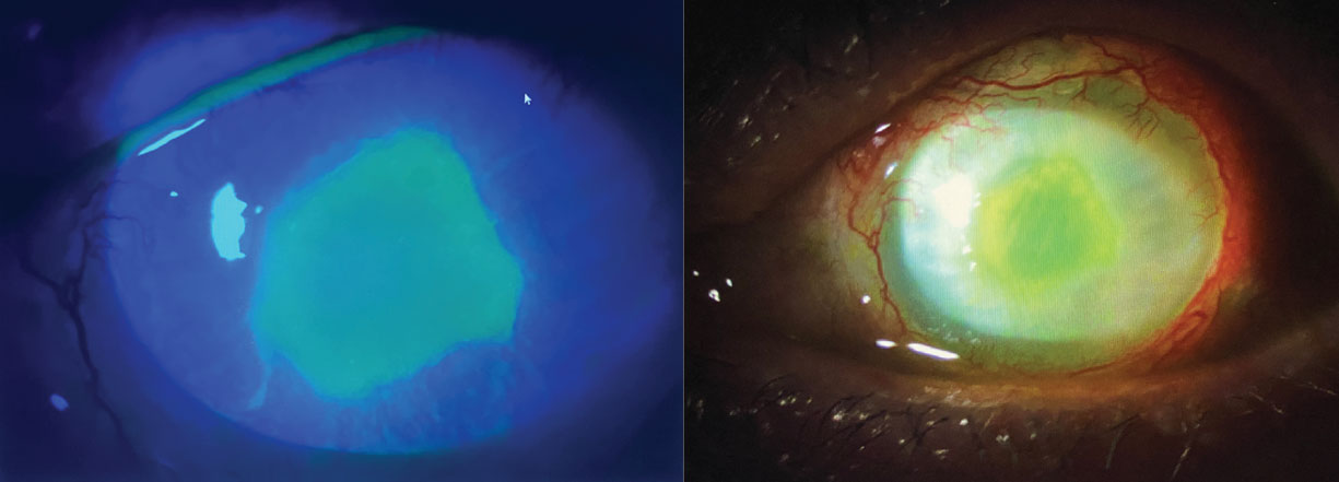 Fig. 2. Pseudomonas aeruginosa corneal ulcer. Epithelial defect overlies and mirrors the size of round, central stromal infiltrate.