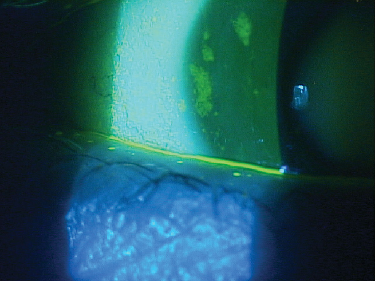 Fig. 5. Patchy staining and minimal tear meniscus height in a patient with Sjögren’s syndrome keratoconjunctivitis sicca.