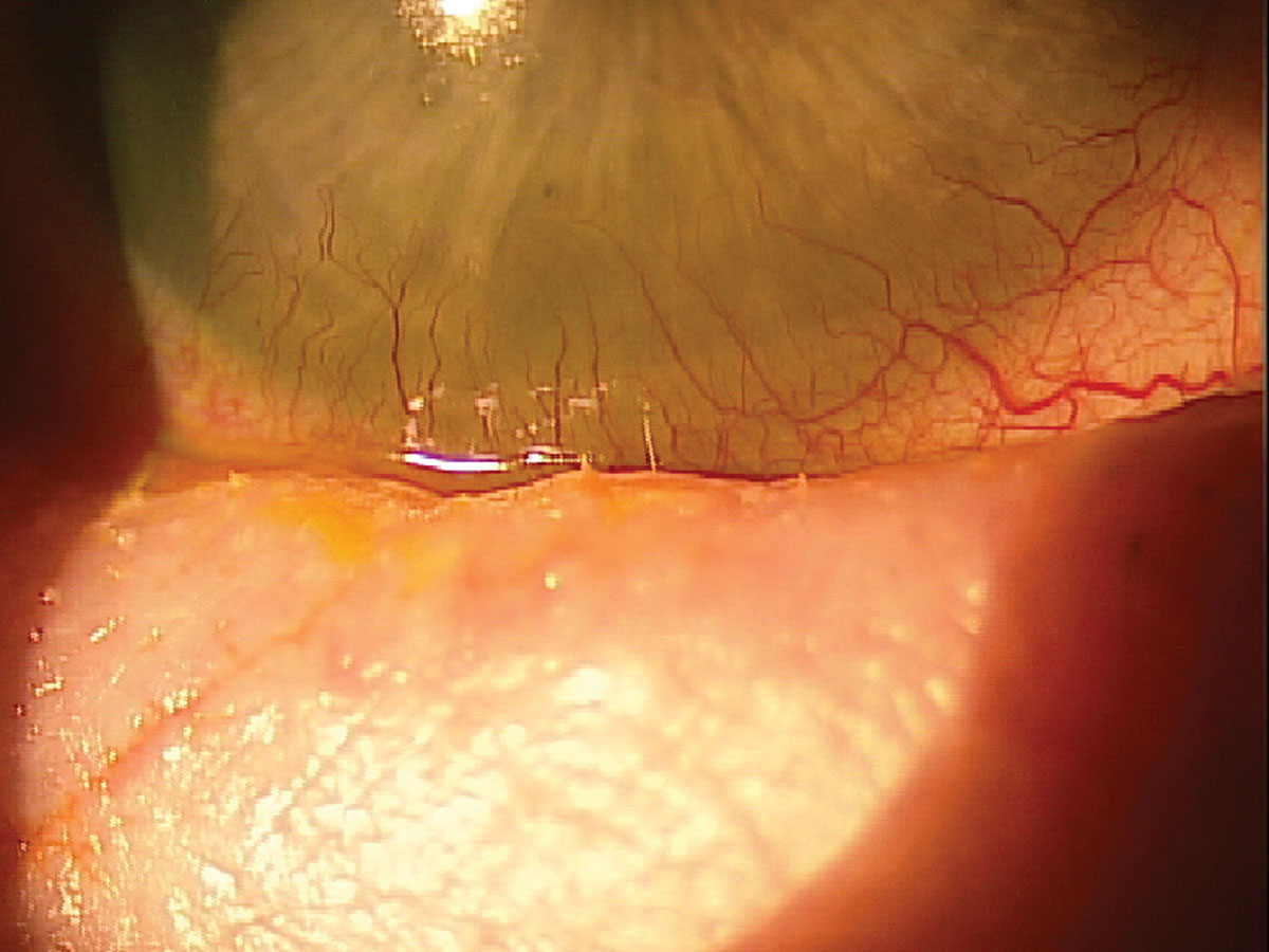 Fig. 8. A patient with GVHD experiencing trichiasis and severe inflammation.