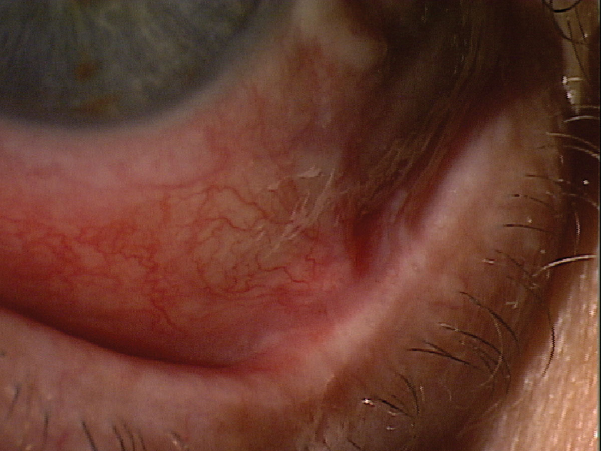 Fig. 6. This patient presented for a dry eye evaluation. The very shortened fornix suggests ocular cicatricial pemphigoid.