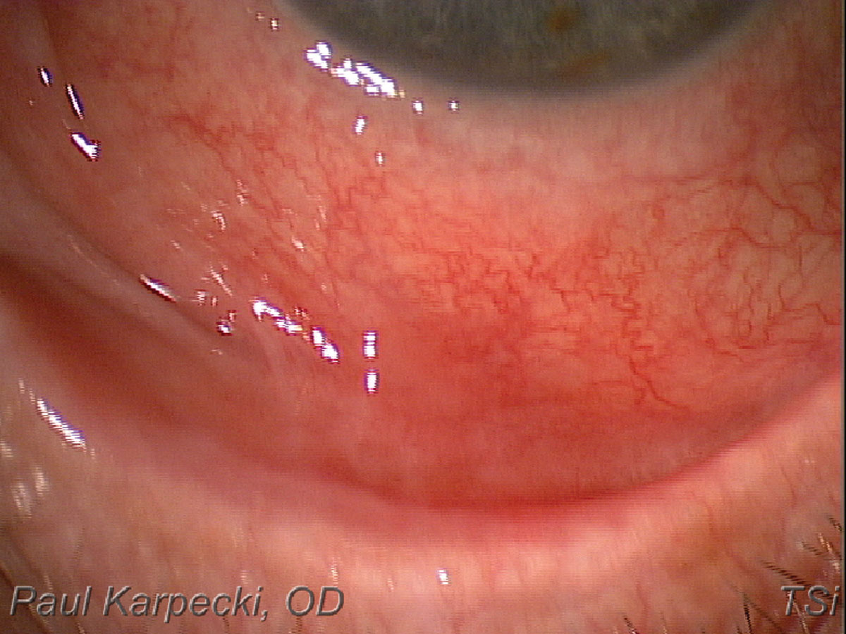 Fig. 7. A shortened inferior fornix, indicative of ocular cicatricial pemphigoid.