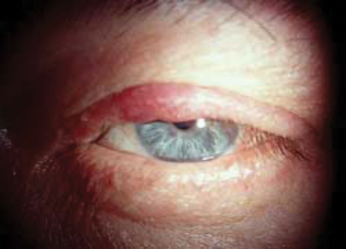 Fig. 1. Sebaceous carcinoma in a patient presenting with a recurrent chalazion.