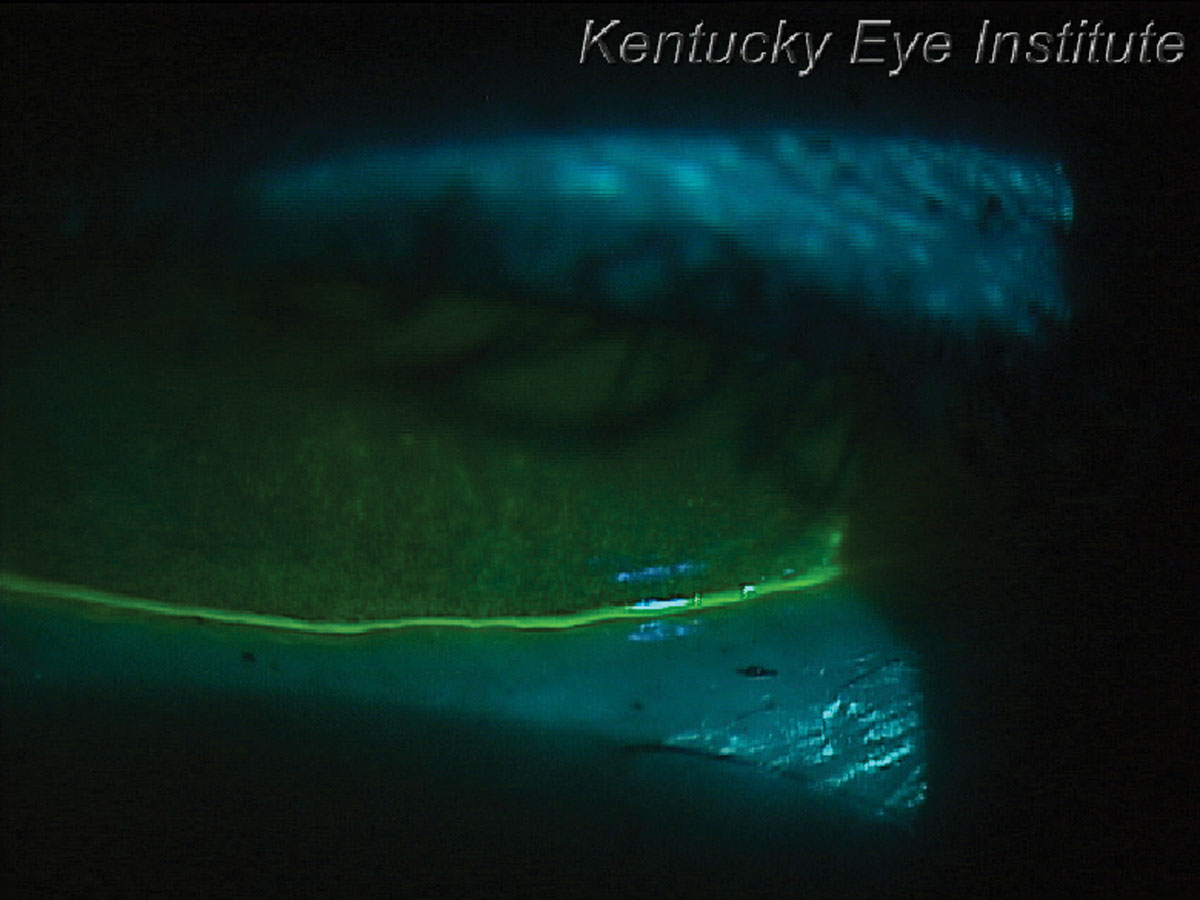 Fig. 4. Thin tear meniscus height and significant corneal staining in a patient with Sjögren’s syndrome k. sicca.