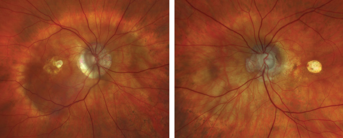 Fig. 1 and 2. Zeiss Clarus fundus photograph of the right eye (left) and left eye (right).