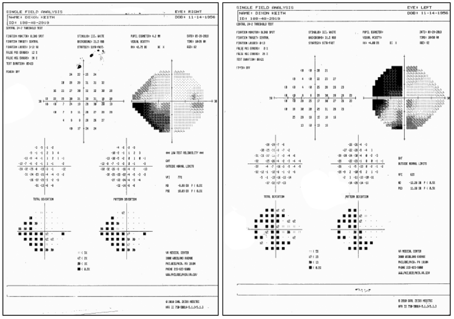 The patient’s visual field results (OD at left, OS at right).