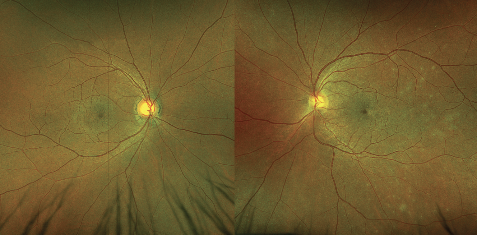 Fig. 1. Right and left fundus photos. The left fundus (right image) has subtle whitish granular lesions in the posterior pole.