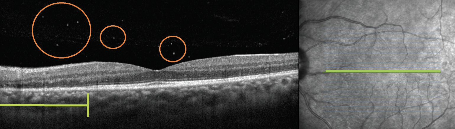 Fig. 2. OCT of the left eye, revealing outer retinal loss of the ellipsoid zone (denoted by underlying green bracket) and subtle vitreous cell (circled in orange). These findings were unilateral.
