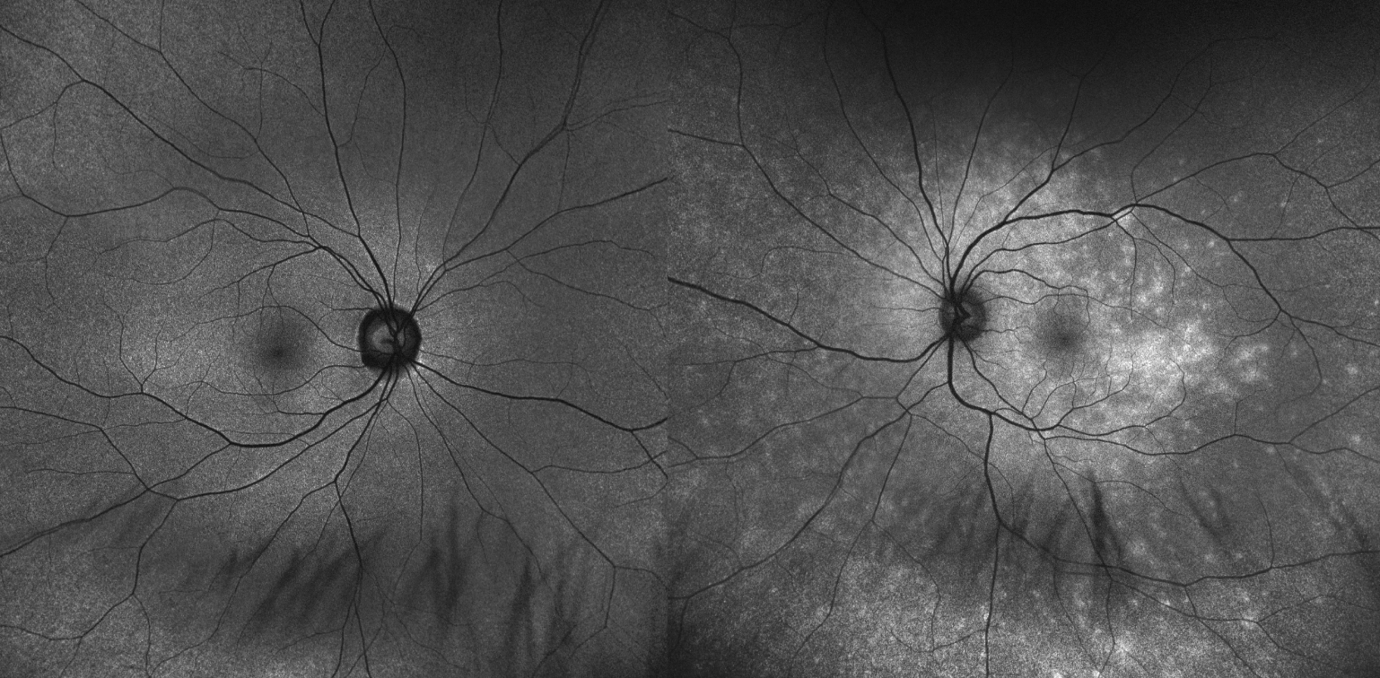 Fig. 3. Montage FAF of the right and left eyes. Spotty hyperautofluorescence is seen throughout the posterior pole, coalescing in the macula of the left eye (right image).