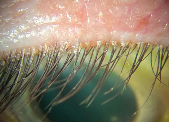 Reduction in collarettes at the base of lashes, number of Demodex tails observed and lash follicle pouting demonstrated the effects of ivermectin cream nightly treatment.
