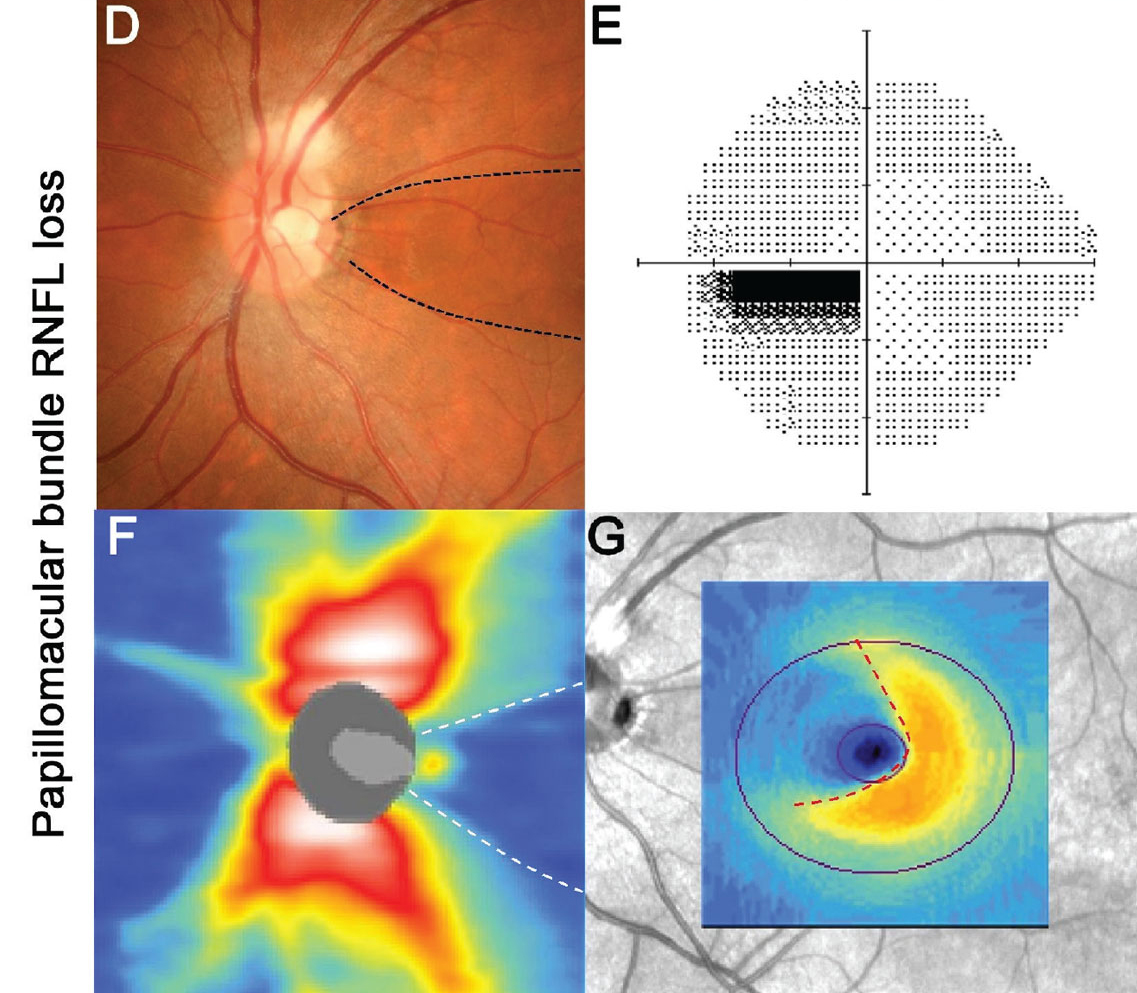 PPA-to-disc-area ratio (odds ratio; OR: 3.83), lamina cribrosa defect (OR 2.92) and central visual field defect (OR 3.56) were significantly associated with the papillomacular bundle defect.