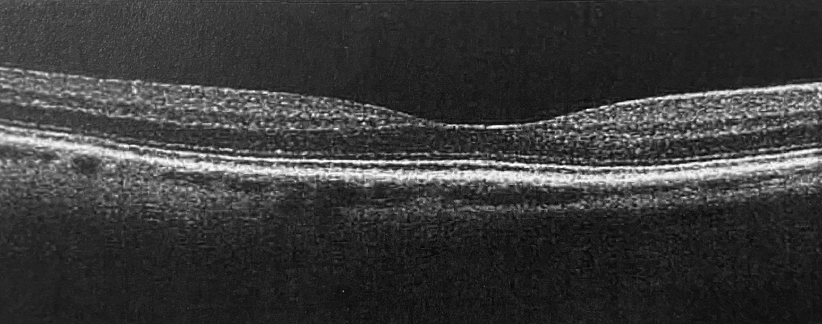 The first OCT was obtained by the first eye doctor. This horizontal scan of the posterior pole of the right eye was taken with Optovue.