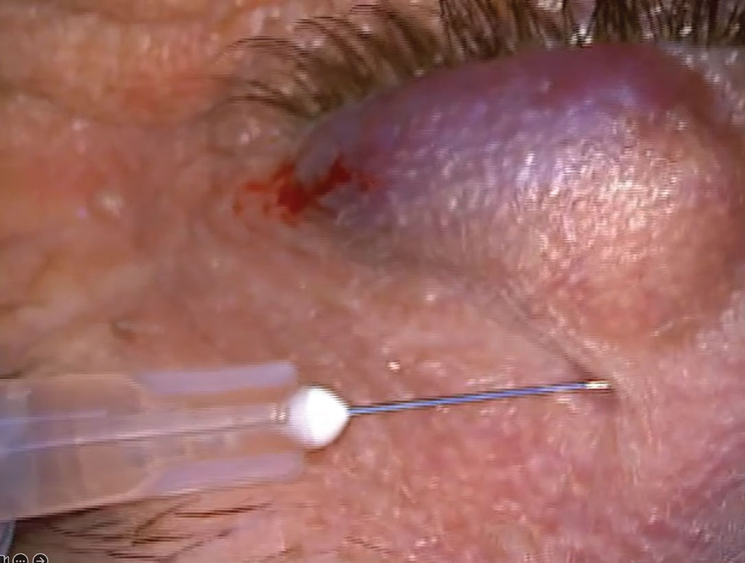 Fig. 7. Ecchymosis after intradermal anesthetic injection before chalazion incision and curettage.