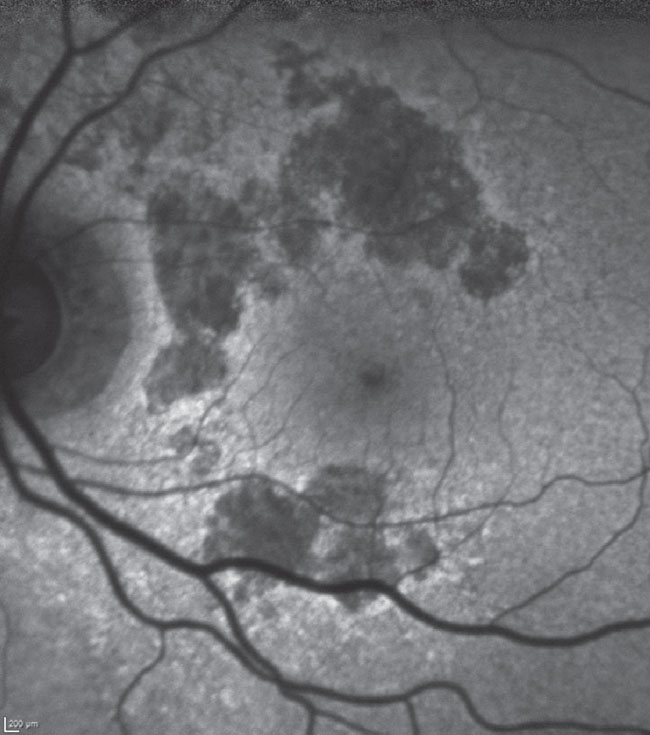 Fig. 1. Fundus autofluorescence of the patient’s left macula. Hypofluorescent areas are surrounding, but not involving, the foveal avascular zone, especially above the horizontal raphe. The patient maintains good visual acuity at 20/40 in this eye.