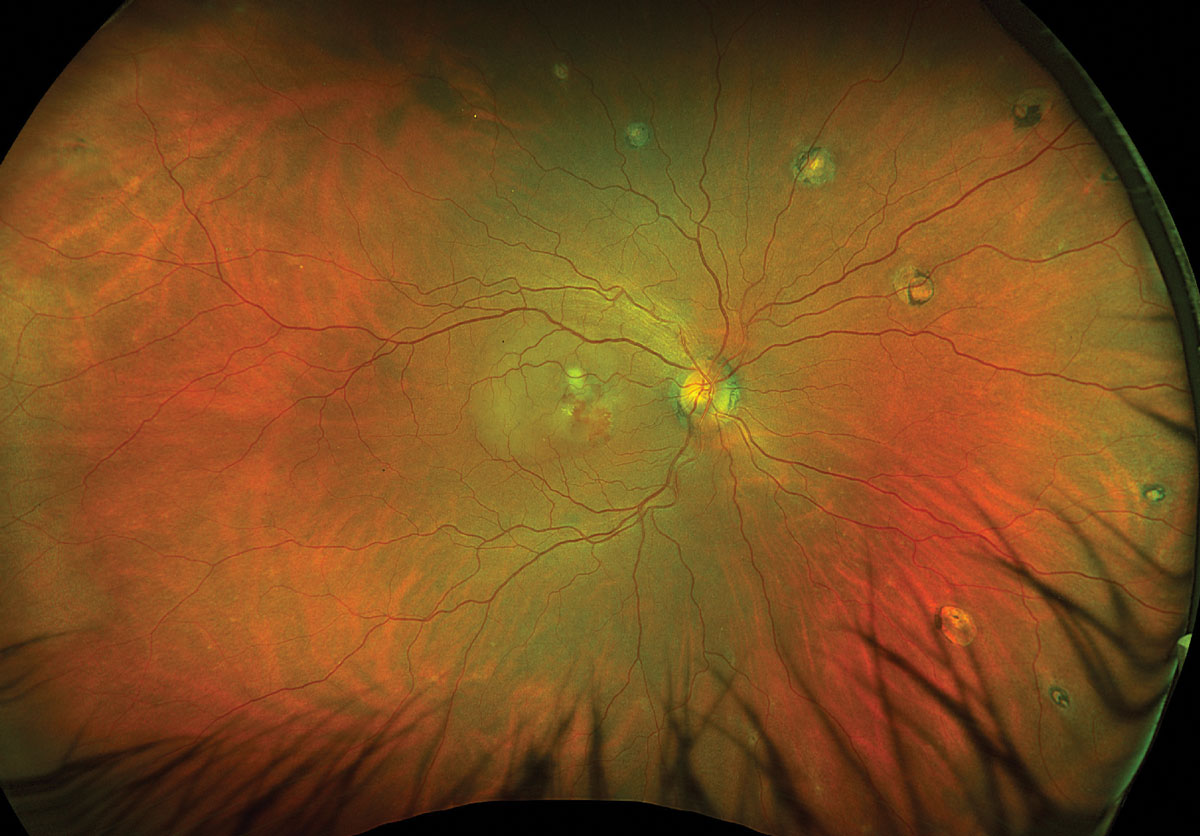 Fig. 1. Optos ultrawidefield fundus photo of the right eye.
