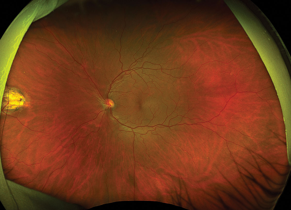 Fig. 2. Optos ultrawidefield fundus photo of the left eye.