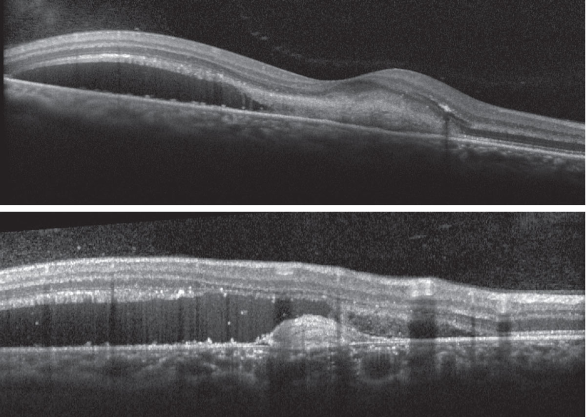 Fig. 3. Heidelberg Spectralis OCT of the right macula (foveal and extrafoveal scan).