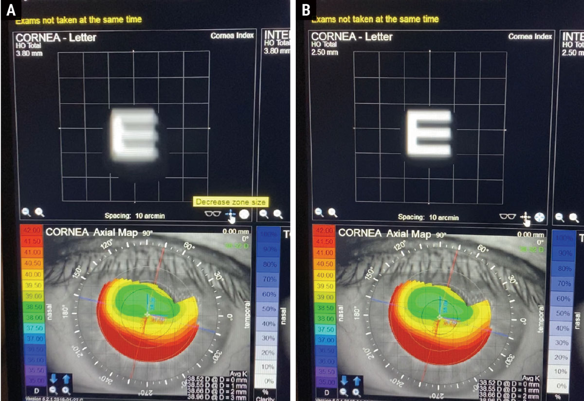 A post-refractive myopic LASIK patient presenting for a cataract eval with a decentered ablation. Here, the iTrace is able to show the benefit of a small-aperture IOL. Left is the simulated image of an E with the patient’s normal pupil size (A). Right shows the improvement in the simulated image with a small aperture IOL (B).