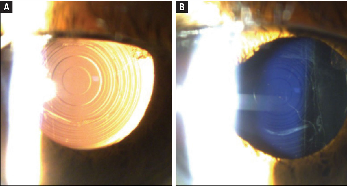 This patient has a Symfony OptiBlue IOL. Figure (A) shows the echellette diffractive design with retroillumination. When viewing the lens directly, you can appreciate the blue hue of the lens (Figure B). The OptiBlue filter blocks the shortest wavelengths of light that produce the most light scatter, helping to mitigate halo, glare and starbursts when driving at night.