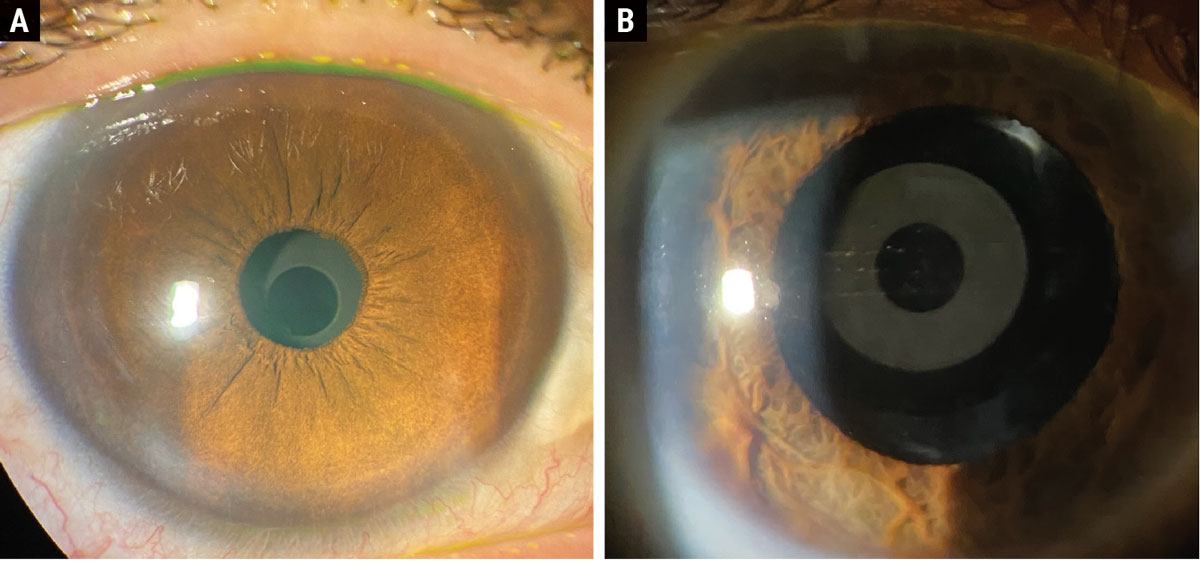 The Apthera pinhole IOL in a post-refractive patient undilated (A) and dilated (B).