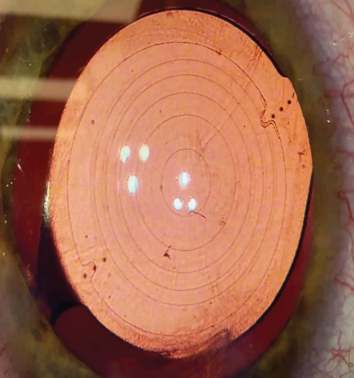 The Ally femtosecond laser (LensAR) creates markings in the lens capsule to precisely place toric IOLs. Here, a toric trifocal lens was used. If a lens is rotated postoperatively, which usually is suspected with a residual mixed refraction, dilating the patient can help to evaluate the alignment of the toric IOL.