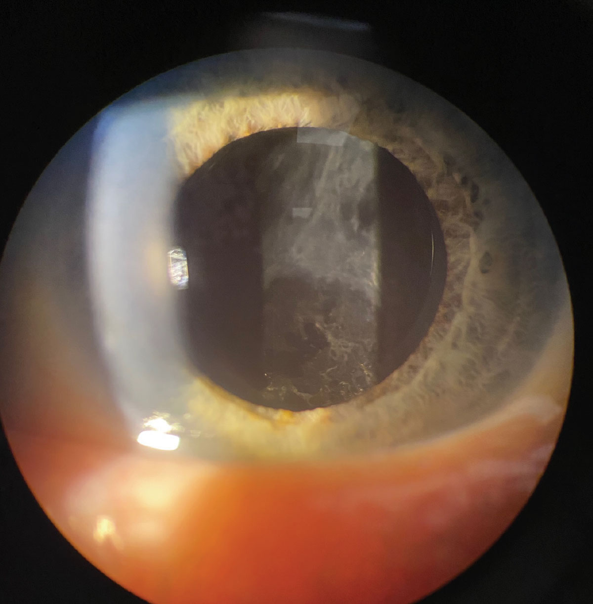 Posterior capsular opacification can be seen in this image. In premium lenses, especially those correcting more than one vision zone such as an EDOF or trifocal lens, mild posterior capsular opacification can cause severe halo/glare effects.