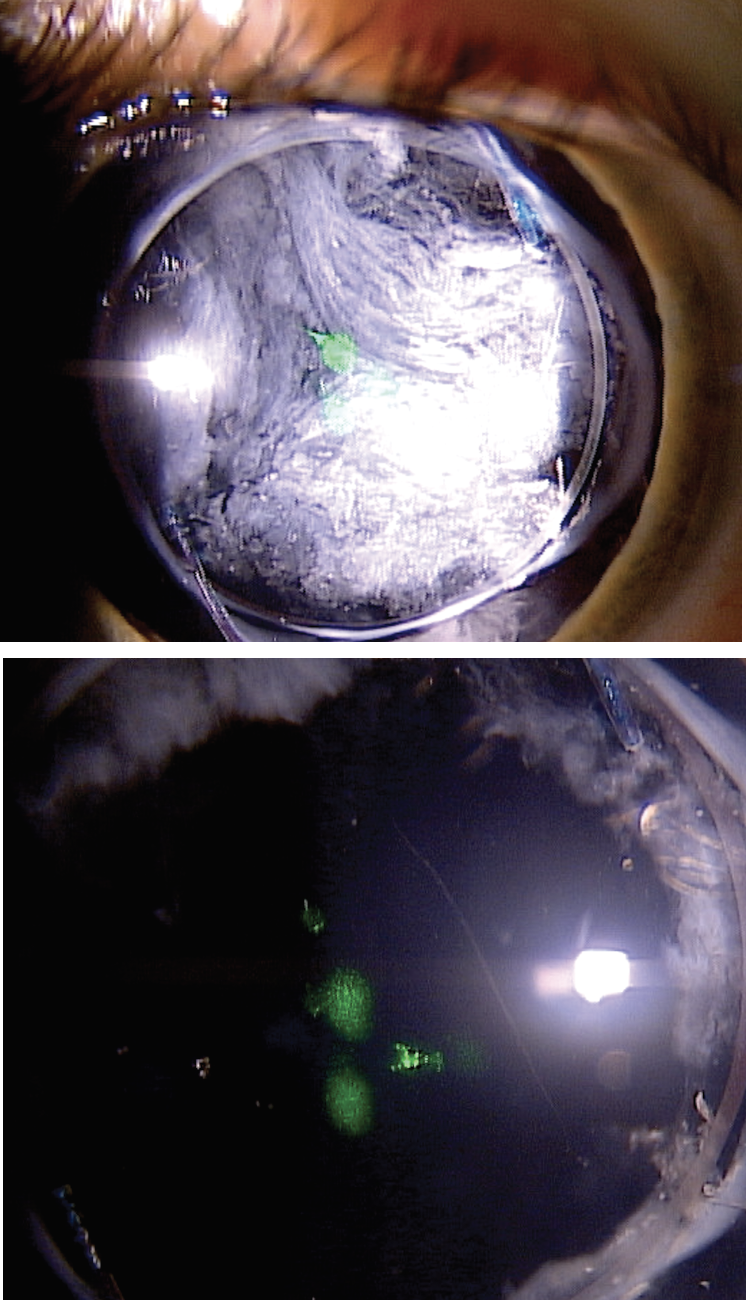 Fig. 5. Patient before (top) and after (bottom) YAG posterior capsulotomy.