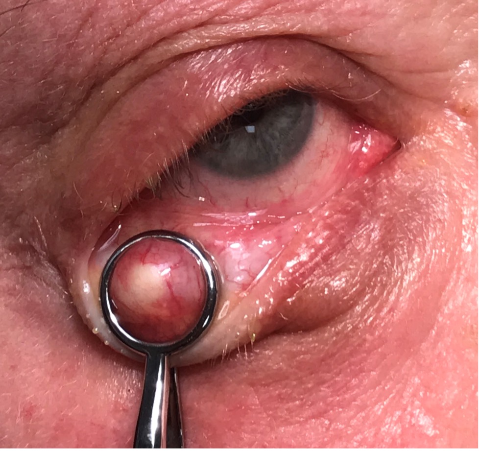 Fig. 3. Clamps are necessary for chalazion/lesion removal to prevent the mass from moving during the procedure.