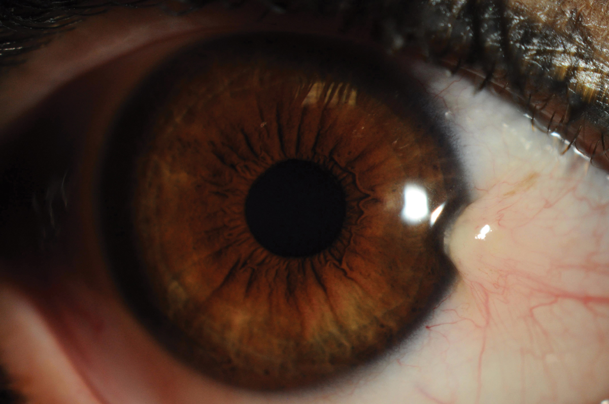 Pterygium horizontal length and thickness affected visual function more than width.