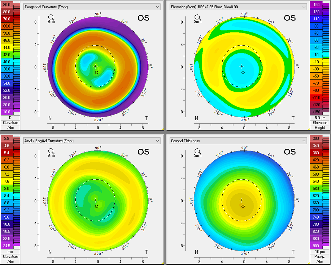 The researchers determined that measuring the distance between the most obvious point within the pigmented arc and the pupil center can also be done with a slit lamp since the pigmented arc is always located in the inferior reverse curve area.