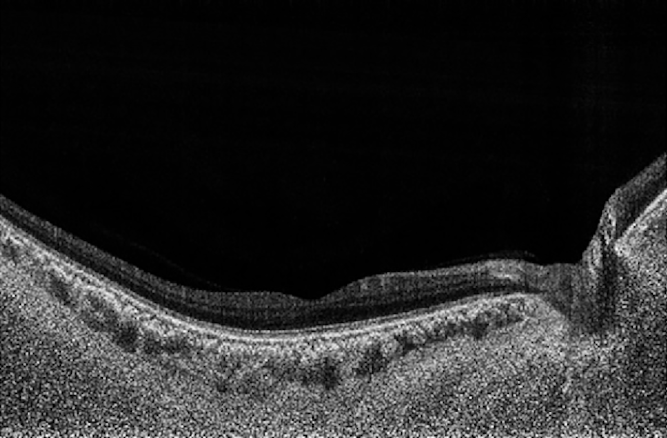 3D widefield OCT scans appear to detect structural glaucomatous damage better than traditional scans of the optic nerve head or macula, study finds.