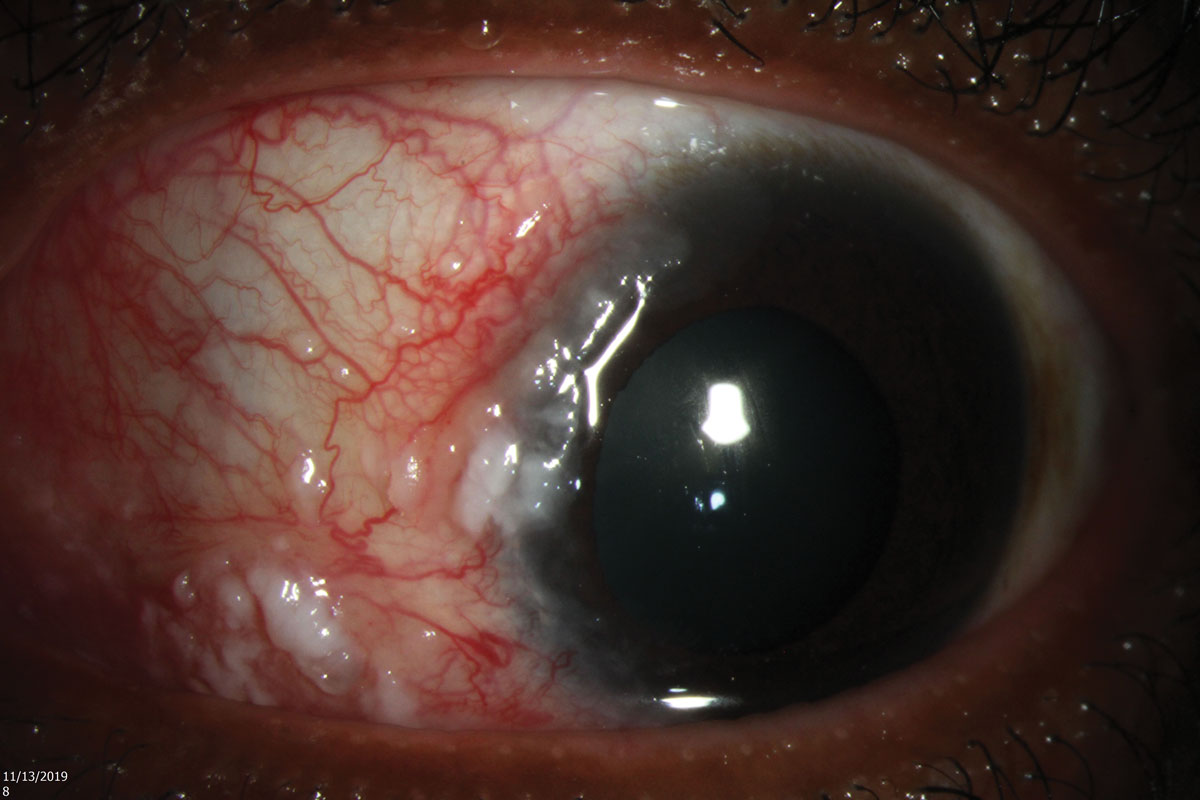 Since originally surveyed in 2003, cornea specialists cited a dramatic increase in their use of primary topical monotherapy and have moved away from surgical excision alone for the treatment of ocular surface squamous neoplasia.