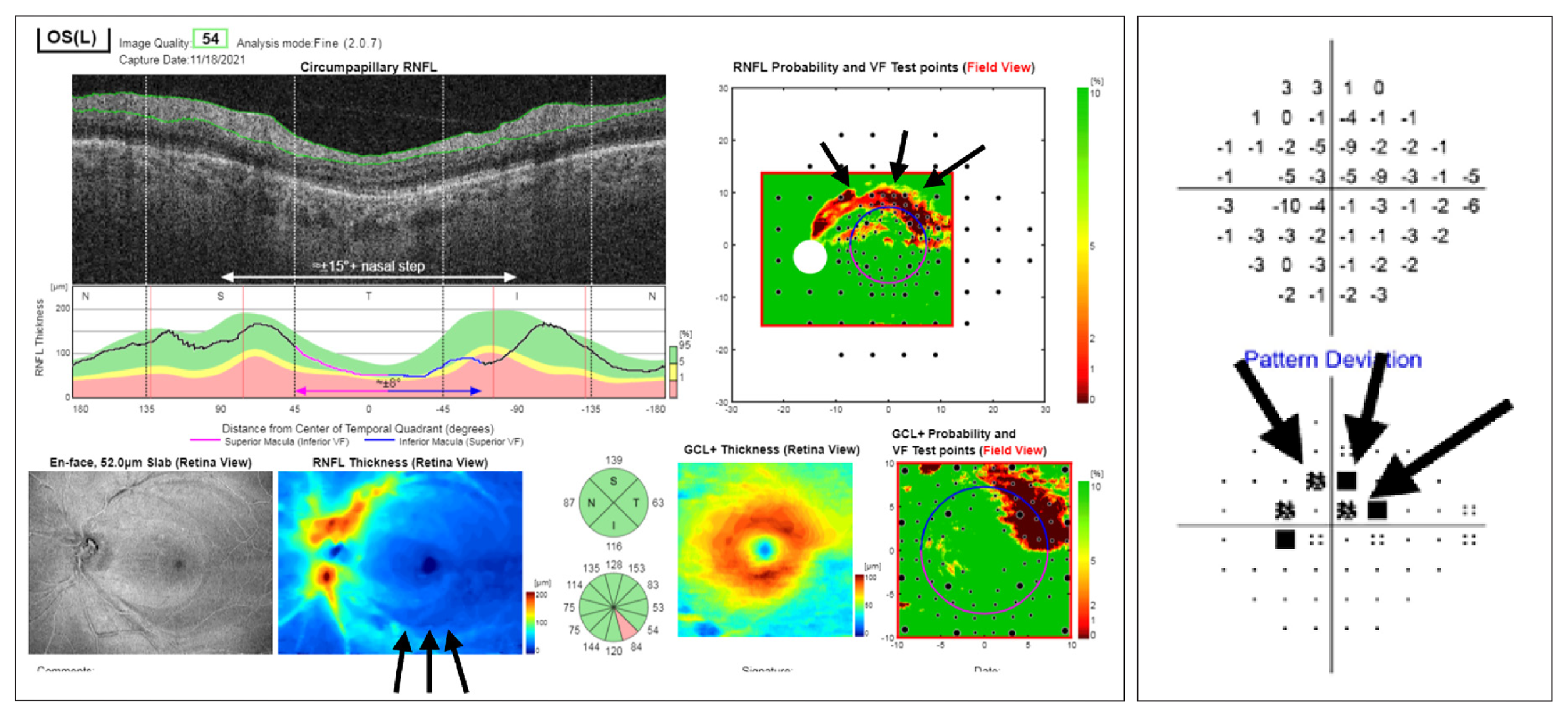 Application of this screening method might help providers who are not glaucoma specialists to determine who should and should not be referred for further evaluation and need for treatment. The OCT report is composed of probability and thickness maps for the RNFL and GCL as well as circumpapillary RNFL B-scan and thickness plot, all of which are used for classification by the Columbia method. In this case, there is an arcuate-like inferior hemiretinal defect that corresponds to the superior arcuate defect on the 24-2 visual field (black arrows).