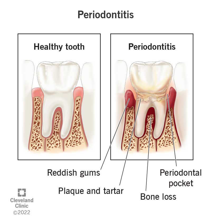 Bone loss from periodontal disease is the result of an immune response to plaque biofilm and metabolic byproducts. Treatment goals include plaque elimination and reestablishment of a healthy, maintainable oral environment.